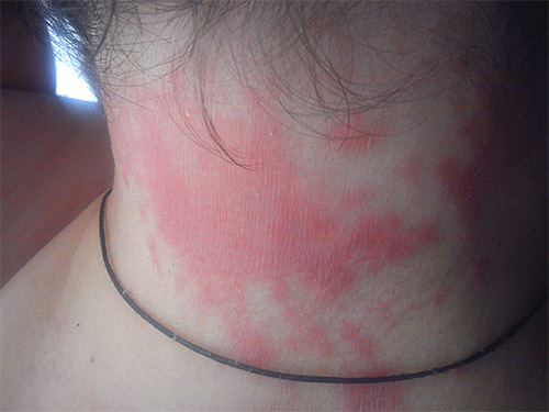 If you are prone to allergies, using the Knicks may cause a rash on the neck and scalp.