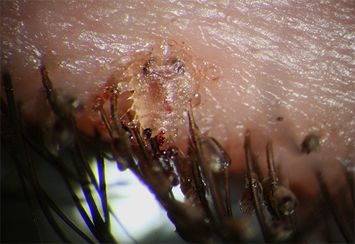 Pubic louse on eyelashes