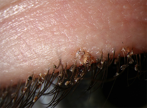 Pubic lice and their nits on the eyelashes of a person