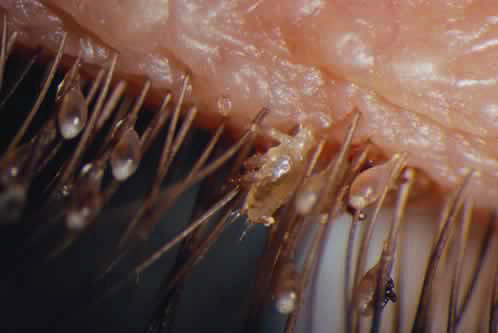 Another photo of pubic lice and nits on the eyelashes