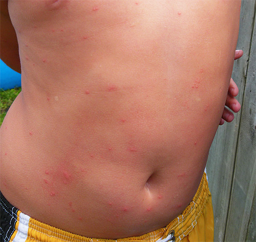 Lice bites kan åtföljas av allergiska utslag.