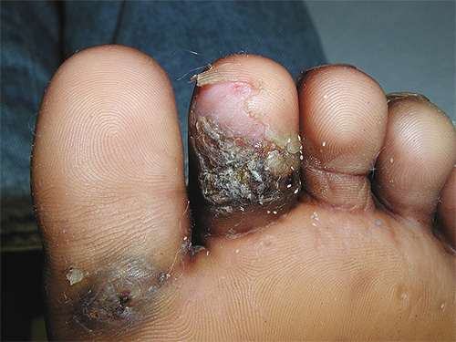 The abscess and exfoliation of the skin due to the sand flea bite