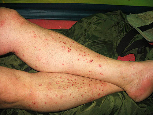 Feet covered with sand flea bites