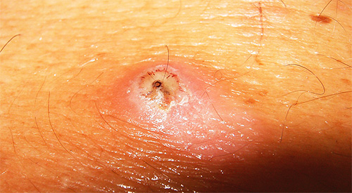 The photo shows a sand flea bite site: a female has penetrated under the skin.