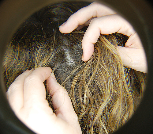 Let's talk about proper and effective treatment for lice and nits on the head.