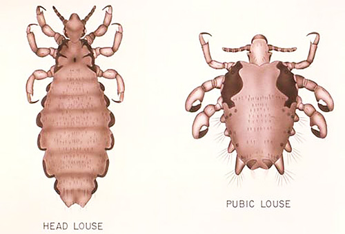 The picture clearly distinguishes between head and pubic louse.