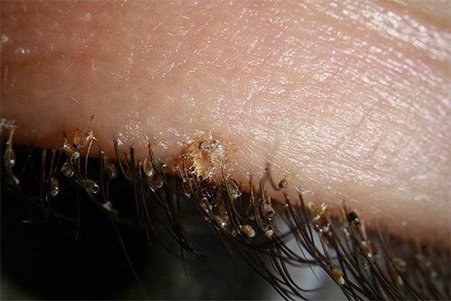 Pubic lice can also parasitize a person’s eyelashes