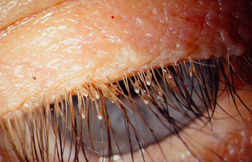 Nits of pubic lice on eyelashes are clearly visible.