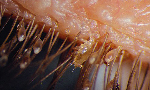 This photo also clearly shows the pubic louse among the eyelashes and numerous nits.