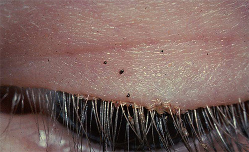 Another photo of pubic lice and nits on human eyelashes