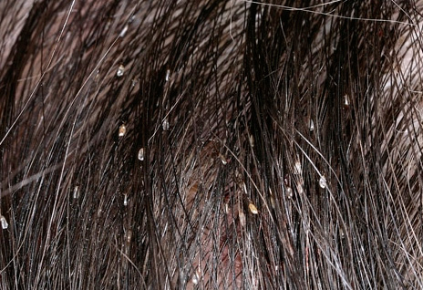 Louse itself can not be noticed when viewed from the head, but the nits immediately catch the eye