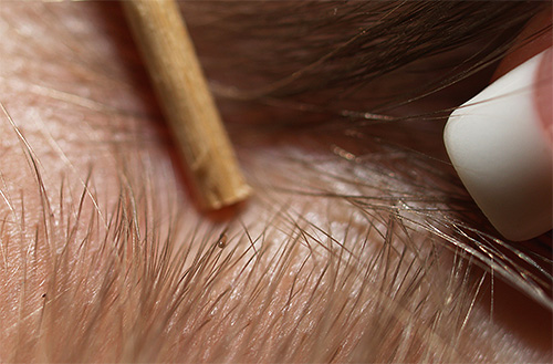 Lice larvae can be quite difficult to see among hair