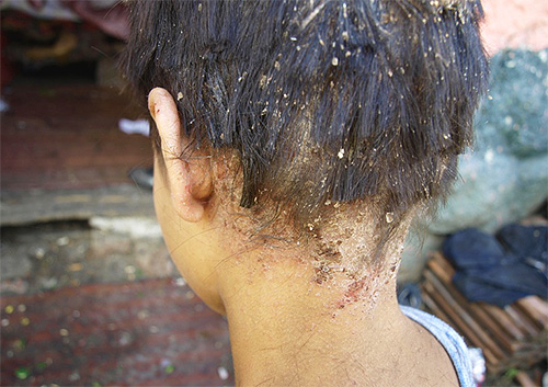 The photo shows an example of running pediculosis.