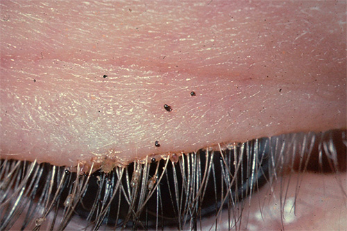 Another photo where you can see lice and nits on the eyelashes of a person