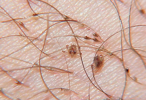 Pubic lice on human hair