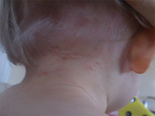 Spår av löss biter på barnets hud