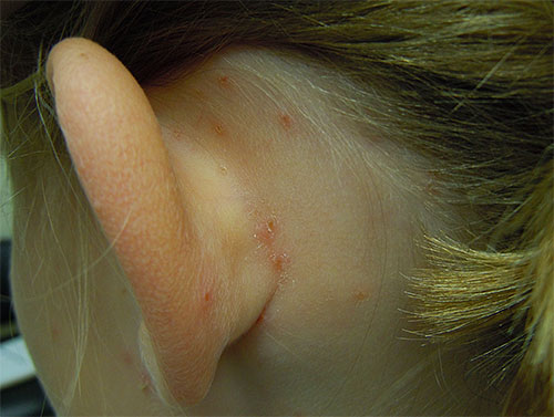 Dessa bett ses mest på nacken och bakom öronen på ett barn.