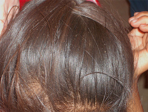Nits på håret liknar ett kluster av vita prickar.