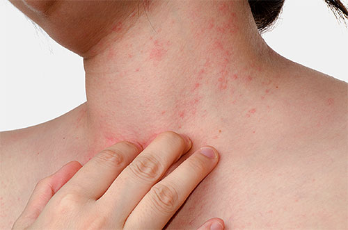 A rash on the body is only one of the consequences that threaten when trying to remove lice with Dichlorvos