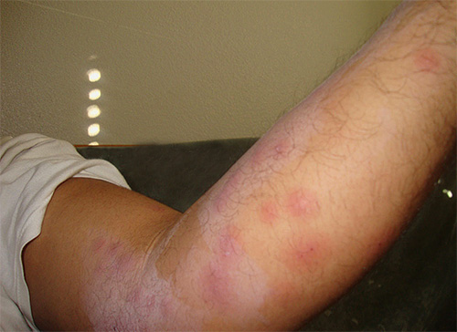 The first bites of bed bugs in an apartment are often mistaken for mosquito bites or allergies.