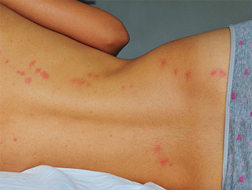Bedbugs bites är vanligtvis placerade på kroppen i kedjor