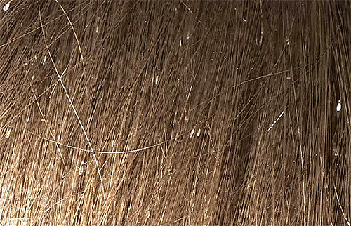 Nits in the hair - a characteristic symptom of infection with lice