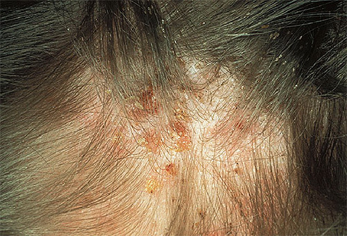 With severe lice infection, the symptoms are similar to those that occur with dermatitis.