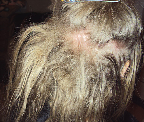 The presence of lice in the hair is also indicated by a sign such as mats