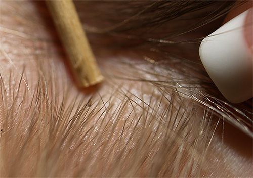 If you dissolve the hair with your fingers or tweezers, then you can well consider the nits and the lice themselves