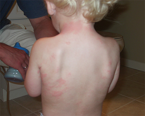 Tea tree oil can be a strong allergen, especially for a child.