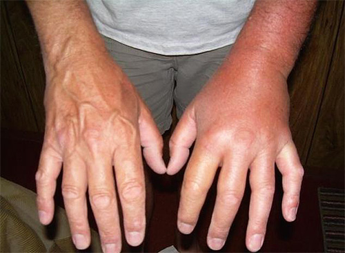 The photo shows a hand swollen after a hornet bite