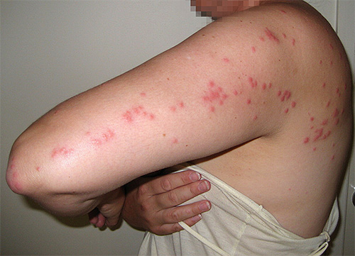 Flera bete av bedbugs är farliga eftersom de orsakar allvarliga klåda och allergiska utslag.