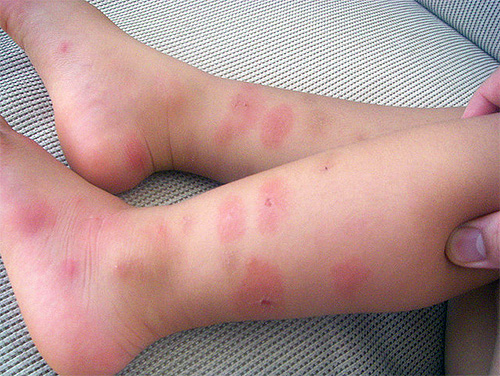 Det är svårt för barn att hålla sig från att klia sina bitar, vilket innebär att dessa sår är öppna grindar för infektioner.