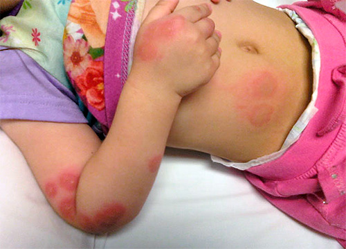 Bedbug bites hos barn är särskilt farliga och kan ha långvariga effekter.