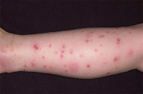Flea bites can cause allergic reactions and dermatitis