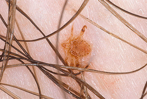 There are many folk remedies for the treatment of pubic lice, but not all of them are effective.