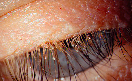 Pubic lice can infect human eyelashes and eyebrows.