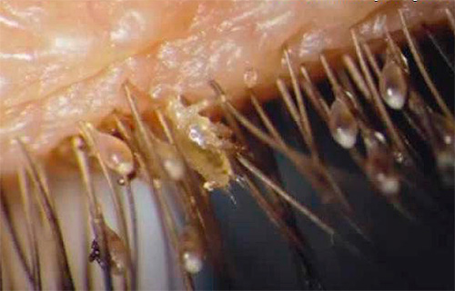 The photo clearly shows lice and nits on the eyelashes.