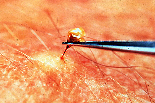 The photo shows the removal of a bee sting with tweezers.