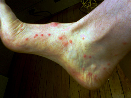 När en loppbett injicerar sekretioner av speciella körtlar under huden, vilket orsakar den primära allergiska reaktionen.