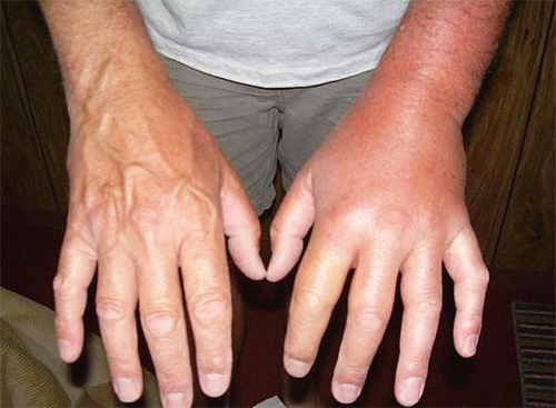 The body’s first response to sting is extensive tissue edema.
