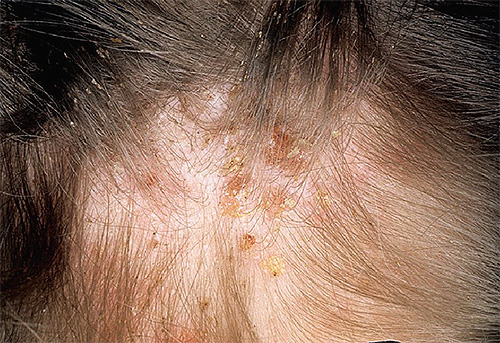 Lice bites are often complicated by concomitant allergies and pustular inflammations.