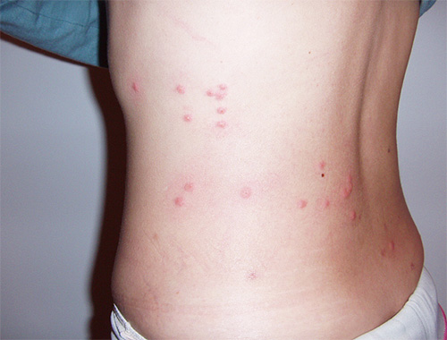 Bedbugs, biting a person, often leave on the body a characteristic path of bites