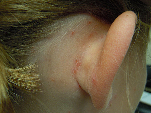 The photo shows the combed bites of lice behind the ears of a child.