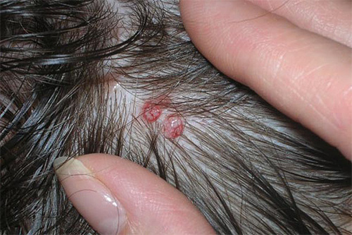 Combing lice bites can develop into serious pyoderma