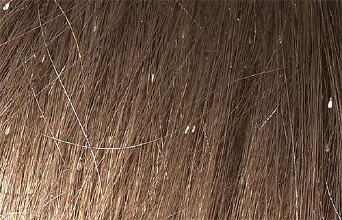 The whitish color of the nits are particularly well visible on dark hair.