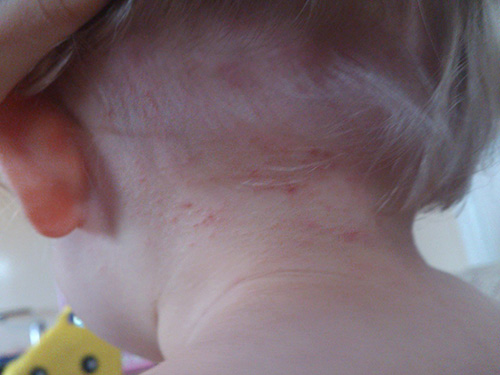 De röda pricken är tydligt synliga på fotot - lössplatsen biter på barnets nacke.
