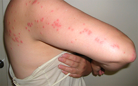 Bedbug bites are guessed by a characteristic chain on the human body