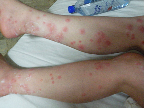 In children, bedbug bites can have particularly serious consequences.