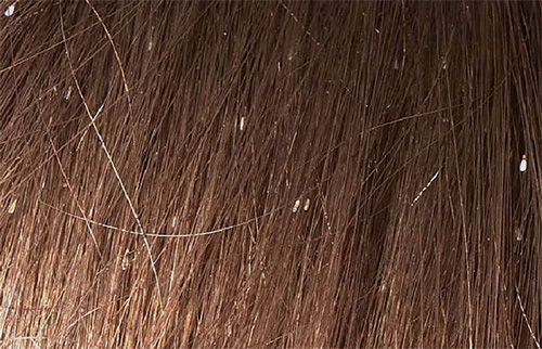 Nits på håret ser ut som små vita prickar